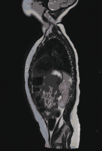 Spina_bifida-Kind Spina_bifida-Kind